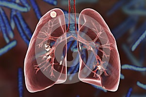 Secondary tuberculosis in lungs