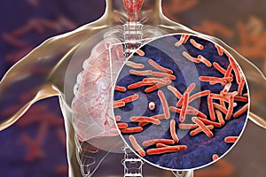 Secondary tuberculosis in lungs and close-up view of Mycobacterium tuberculosis bacteria