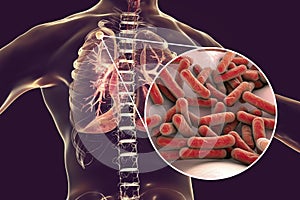 Secondary tuberculosis in lungs and close-up view of Mycobacterium tuberculosis bacteria