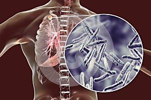 Secondary tuberculosis in lungs and close-up view of Mycobacterium tuberculosis bacteria