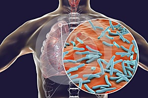 Secondary tuberculosis in lungs and close-up view of Mycobacterium tuberculosis bacteria