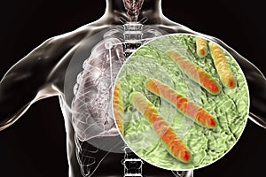 Secondary tuberculosis in lungs and close-up view of Mycobacterium tuberculosis bacteria