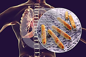 Secondary tuberculosis in lungs and close-up view of Mycobacterium tuberculosis bacteria