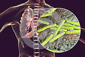 Secondary tuberculosis in lungs and close-up view of Mycobacterium tuberculosis bacteria