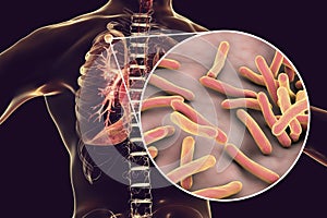 Secondary tuberculosis in lungs and close-up view of Mycobacterium tuberculosis bacteria