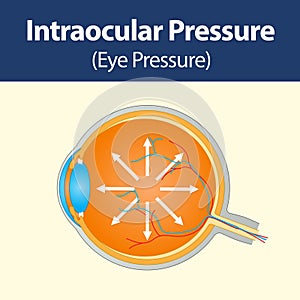 Section of human eye showing intraocular pressure buildup in Glaucoma disease