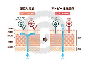 Sectional view of atopic dermatitis and normal skin / Comparative vector illustration Japanese