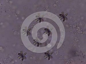 Sediment sulfonamide crystal in urine