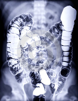 Selective focus of Barium enema photo