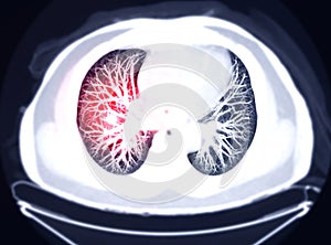 Selective Focus of CT Chest AXIAL MIP view for diagnostic Pulmonary embolism PE.