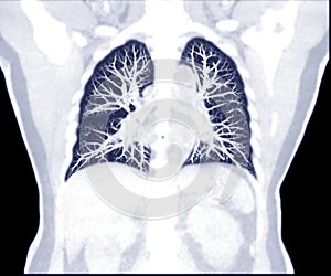 Selective Focus of CT Chest Coronal MIP view.