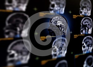 Selective focus of MRI brain sagittal plane for detect a variety of conditions of the brain. photo