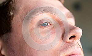 Selective focus on swollen and painful red upper eye lid with onset of stye infection due to clogged oil gland and