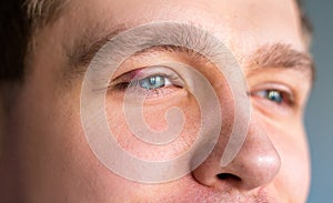 Selective focus on swollen and painful red upper eye lid with onset of stye infection due to clogged oil gland and