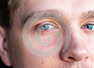 Selective focus on swollen and painful red upper eye lid with onset of stye infection due to clogged oil gland and