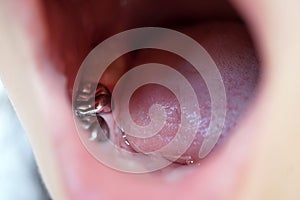 Selective focus for Tooth filling with composite resins called Amalgam Filling.