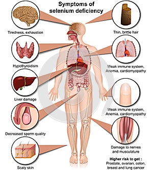 Selenium deficiency medical vector illustration isolated on white background infographic