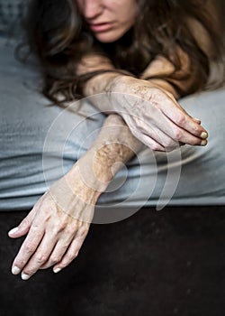 Self harm on frustrated disillusioned sick woman lying on bed with heavy self inflicted Cuts and scars of self-mutilation in