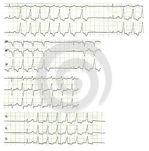 Self-limited ventricular tachycardia. Life-threatening arrhythmia. Electrocardiogram with ventricular cardiac arrhythmia
