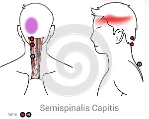 Semispinalis capitis trigger points can cause pain in the back and side of the head