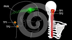 Semispinalis muscles. Trigger points and referred pain