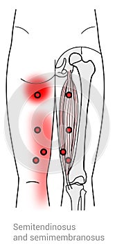 Semitendinosus and Semimembranosus trigger point referral pain areas
