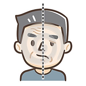 Senior citizen of facial nerve palsy