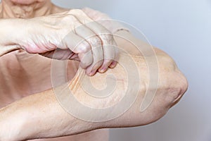 A senior elderly woman holding, pulling the skin on her arm with bad turgor, exces loose skin