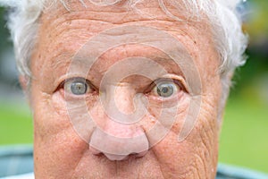 Senior man with anisocoria showing unequal dilation of his pupil