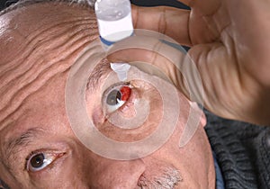 Senior man dripping a red bloodshot eye with eye drops