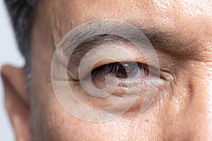Senior man eyestrain after for long stretches at computer or digital screens