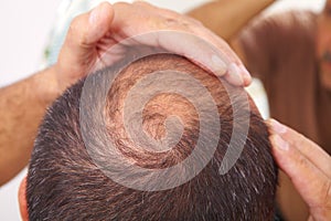 Senior man and hair loss issue