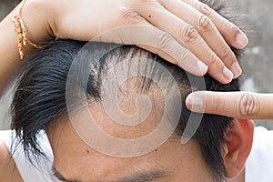 Senior man and hair loss issue