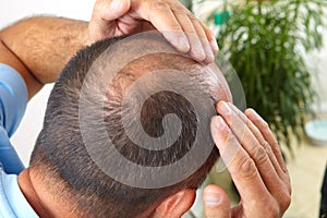 Senior man and hair loss issue photo