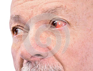 Senior man with irritated red bloodshot eye