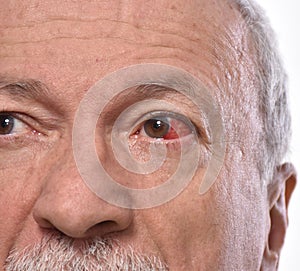 Senior man with irritated red bloodshot eye