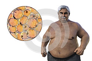 A senior overweight man with a close-up view of adipocytes, 3D illustration highlighting the role of these fat cells in