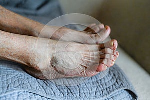 senior woman foot with medical condition, arthritis and fungus