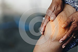 Senior woman holding the knee with pain From knee surgery