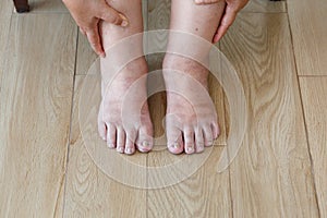 Senior woman swollen feet and leg photo