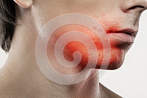 Sensitive skin irritation after a shaving routine