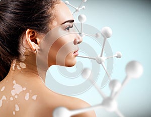 Sensual woman with vitiligo near big white molecule chain.