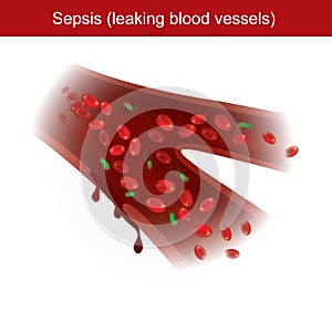 Sepsis. When the body has immune response to bacterial infections, causing inflammation and leaking blood vessels in the body photo
