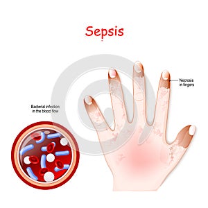 Sepsis. Close-up of cross section of blood vessel with Bacterial infection