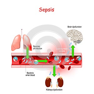 Sepsis. Close-up of cross section of blood vessel with Bacterial infection. photo