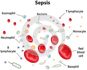 Sepsis