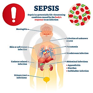 Sepsis vector illustration. Labeled infection condition educational scheme.