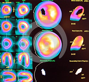 Septal wall ischemia nuclear stress test photo