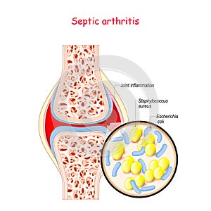 Septic arthritis. Close-up of bacteria S. aureus, E. coli