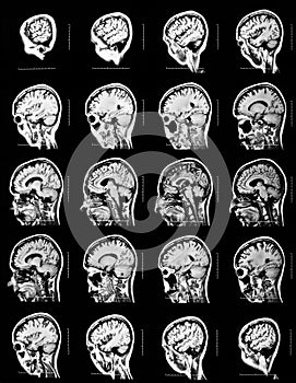 Sequence of vertical sections of a human brain